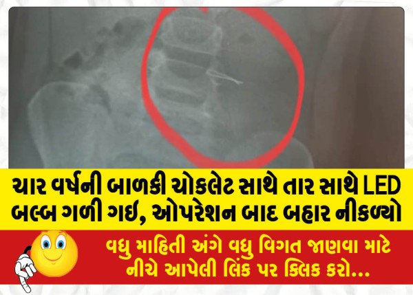 MailVadodara.com - Four-year-old-girl-swallowed-LED-bulb-with-wire-along-with-chocolate-discharged-after-operation