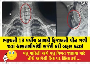 ભરૂચની 13 વર્ષીય બાળકી હિજાબની પીન ગળી જતાં શ્વાસનળીમાંથી સર્જરી કરી બહાર કઢાઇ